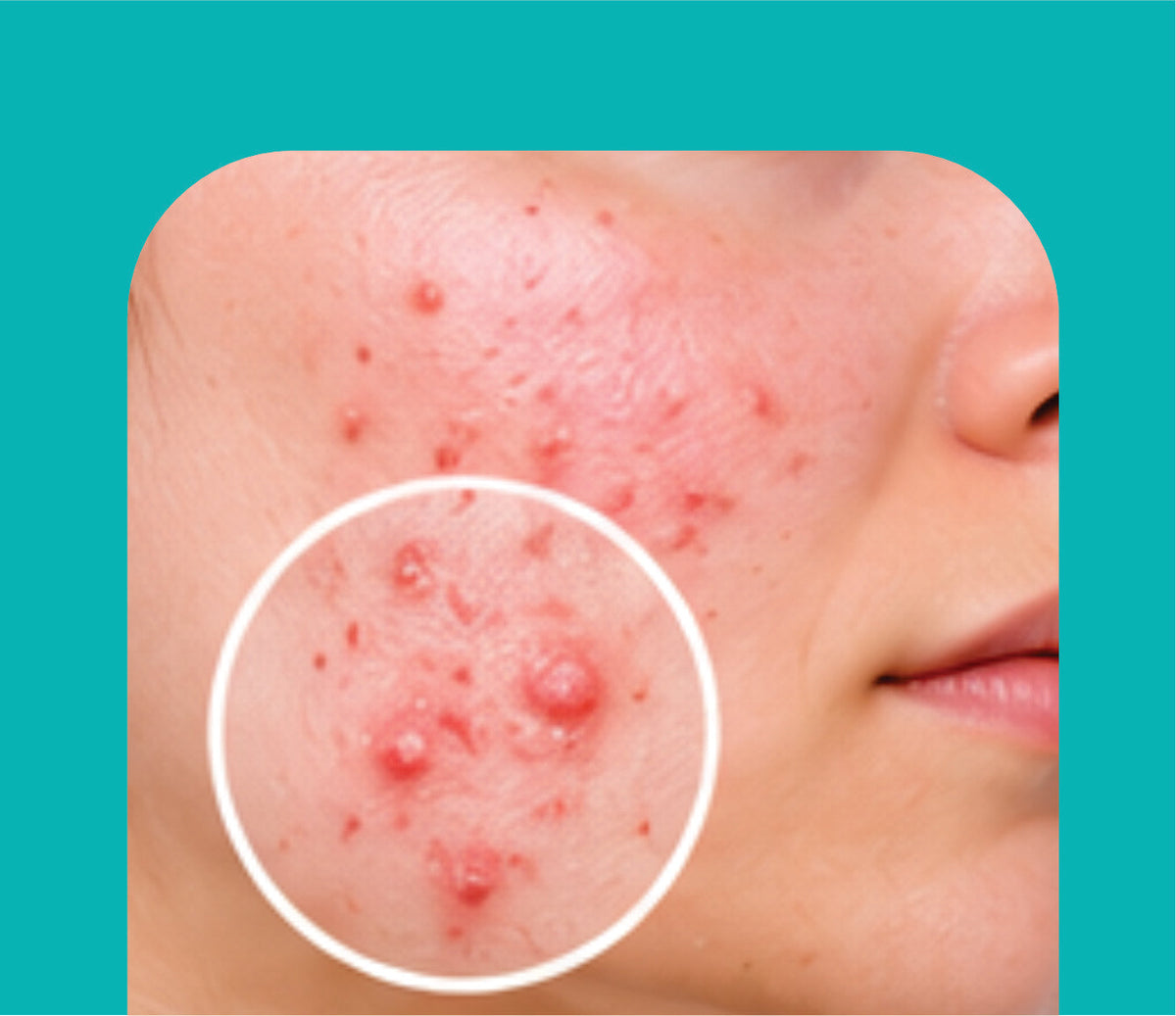 ACNE CARE