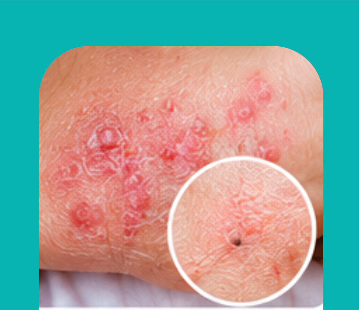 ECZEMA CARE