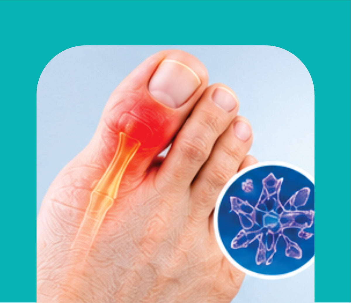 GOUT CARE