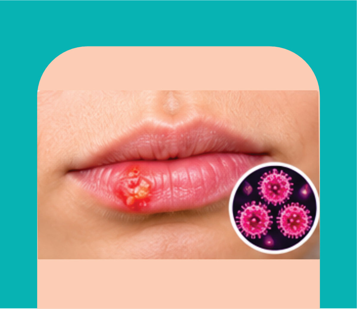 HERPES CARE