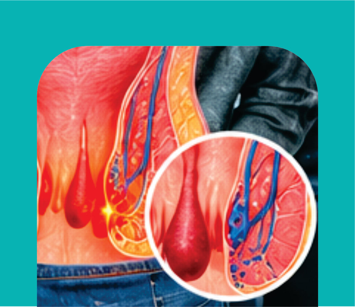 PILES, FISSURES & HEMORRHOIDS