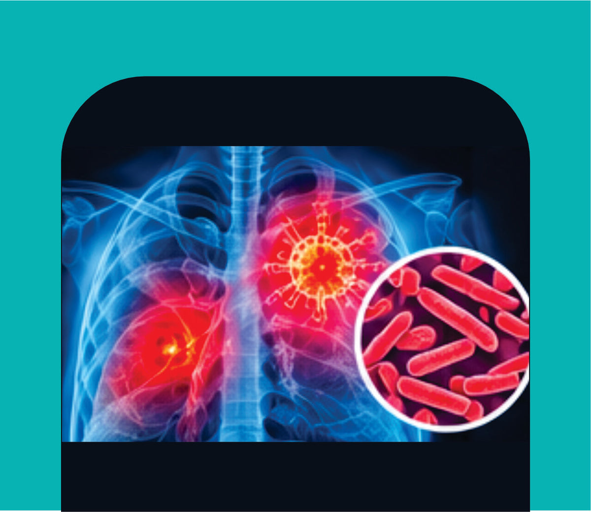 TUBERCULOSIS CARE